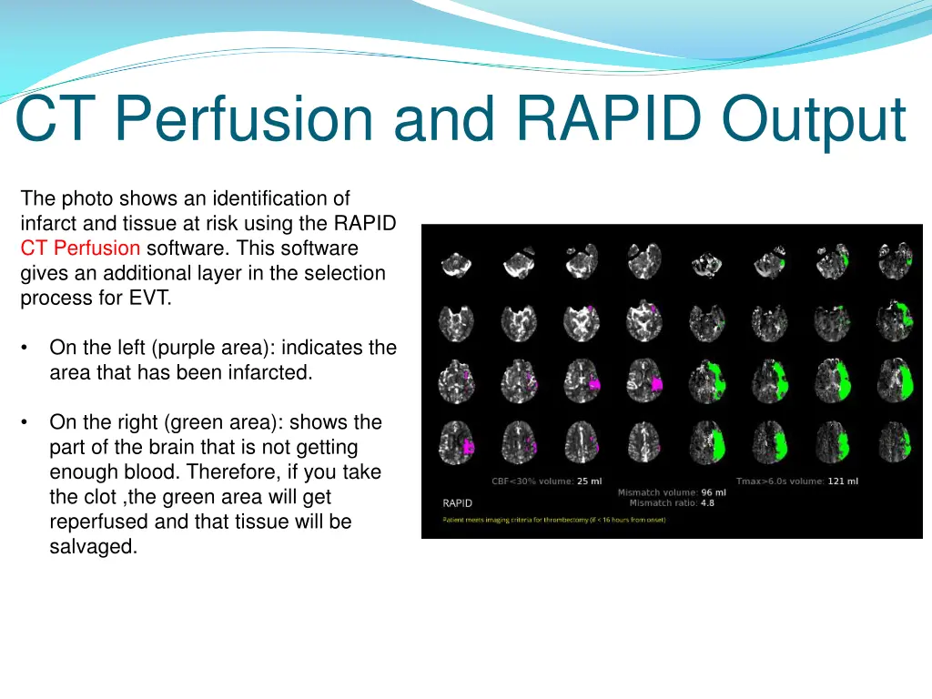 ct perfusion and rapid output