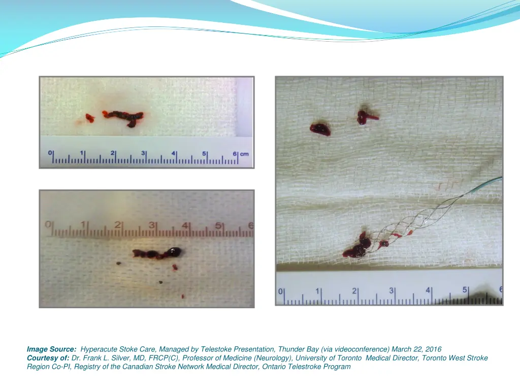 image source hyperacute stoke care managed