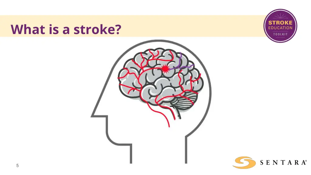 what is a stroke 1